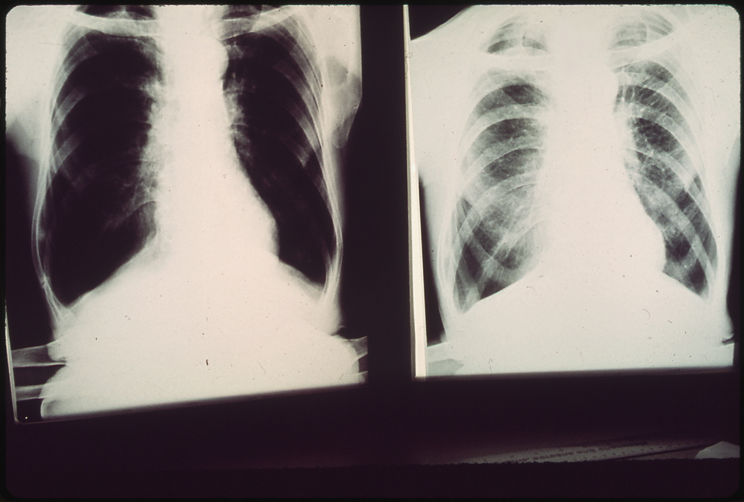 CWP X-Rays